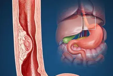 食管癌方面优秀论文选题精选91学术